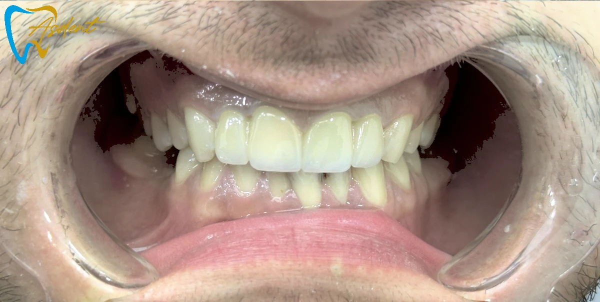 Dental-implants-in-Turkey-Dental-treatment-in-Turkey-Dental-clinic-in-Turkey-After-4.webp Dental-implants-in-Turkey-Dental-treatment-in-Turkey-Dental-clinic-in-Turkey-After-4.webp
