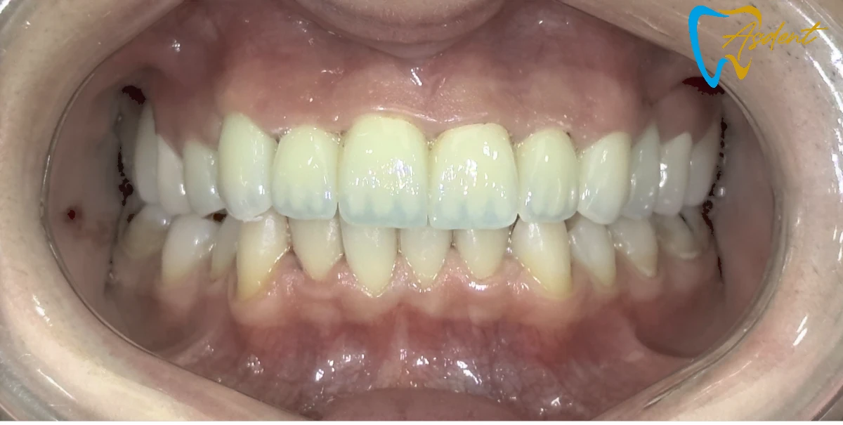 Dental-implants-in-Turkey-Dental-treatment-in-Turkey-Dental-clinic-in-Turkey-After-5.webp Dental-implants-in-Turkey-Dental-treatment-in-Turkey-Dental-clinic-in-Turkey-After-5.webp