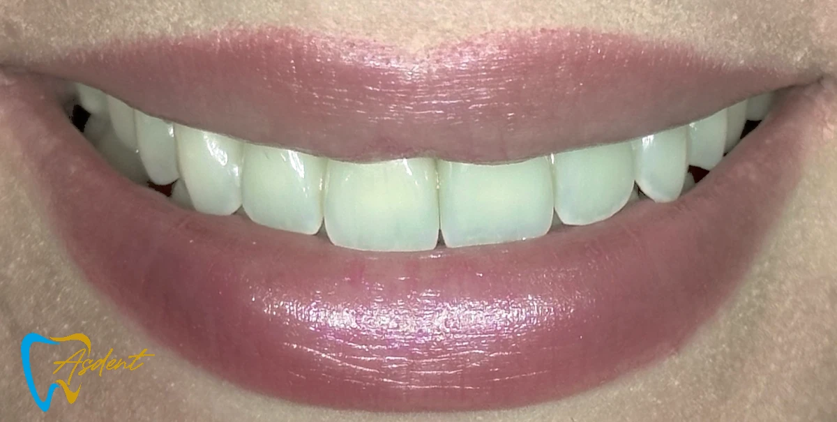 Dental-implants-in-Turkey-Dental-treatment-in-Turkey-Dental-clinic-in-Turkey-After-6.webp Dental-implants-in-Turkey-Dental-treatment-in-Turkey-Dental-clinic-in-Turkey-After-6.webp