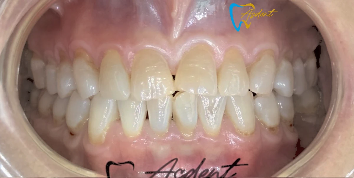 Dental-implants-in-Turkey-Dental-treatment-in-Turkey-Dental-clinic-in-Turkey-Before-1.webp Dental-implants-in-Turkey-Dental-treatment-in-Turkey-Dental-clinic-in-Turkey-Before-1.webp