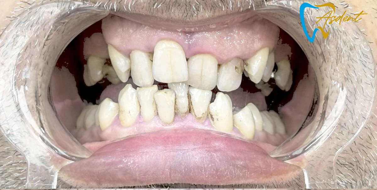 Dental-implants-in-Turkey-Dental-treatment-in-Turkey-Dental-clinic-in-Turkey-Before-2.webp Dental-implants-in-Turkey-Dental-treatment-in-Turkey-Dental-clinic-in-Turkey-Before-2.webp