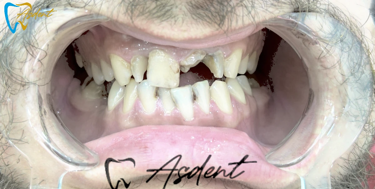 Dental-implants-in-Turkey-Dental-treatment-in-Turkey-Dental-clinic-in-Turkey-Before-4.webp Dental-implants-in-Turkey-Dental-treatment-in-Turkey-Dental-clinic-in-Turkey-Before-4.webp