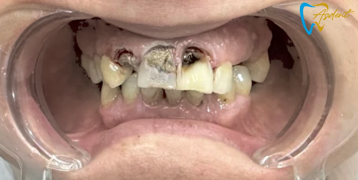 Dental-implants-in-Turkey-Dental-treatment-in-Turkey-Dental-clinic-in-Turkey-Before-7.webp Dental-implants-in-Turkey-Dental-treatment-in-Turkey-Dental-clinic-in-Turkey-Before-7.webp