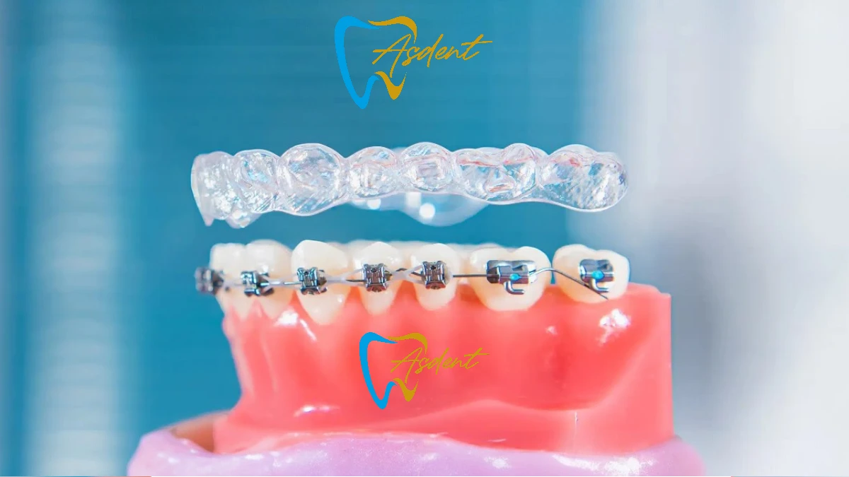 Прозрачные элайнеры Invisalign в Турции