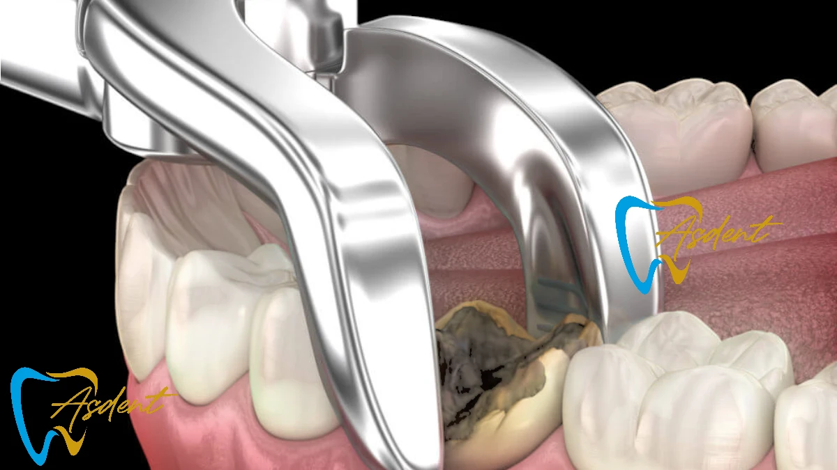 Ağiz ve diş cerahisi Bursa İnegöl ASDENT DENTAL