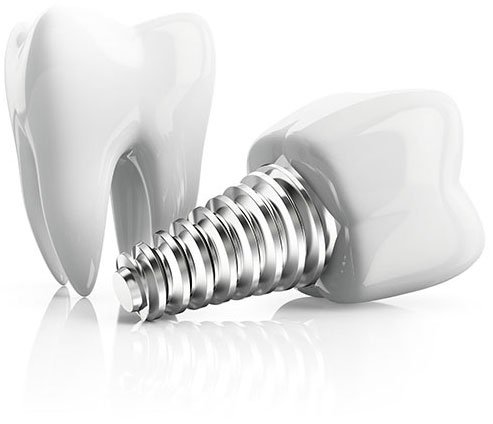 Dental implants in Turkey, Dental treatment in Turkey, Dental clinic in Turkey