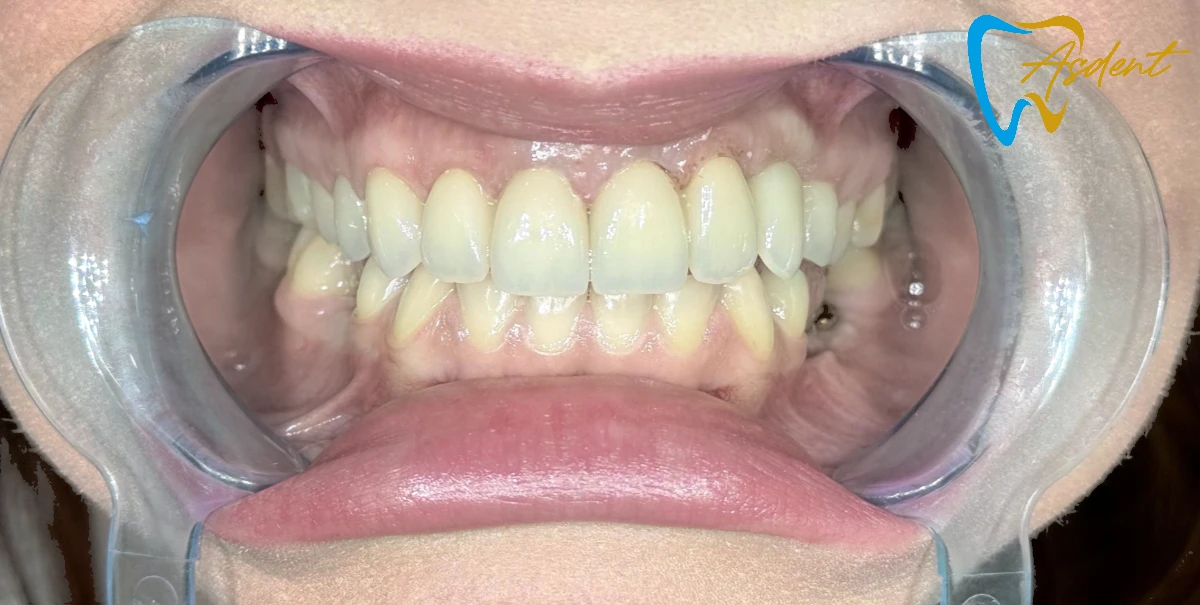 Dental-implants-in-Turkey-Dental-treatment-in-Turkey-Dental-clinic-in-Turkey-After-3.webp