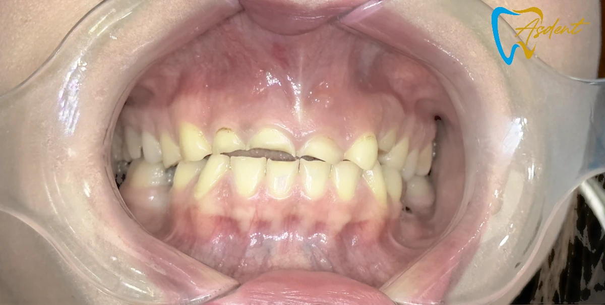 Dental-implants-in-Turkey-Dental-treatment-in-Turkey-Dental-clinic-in-Turkey-Before-3.webp