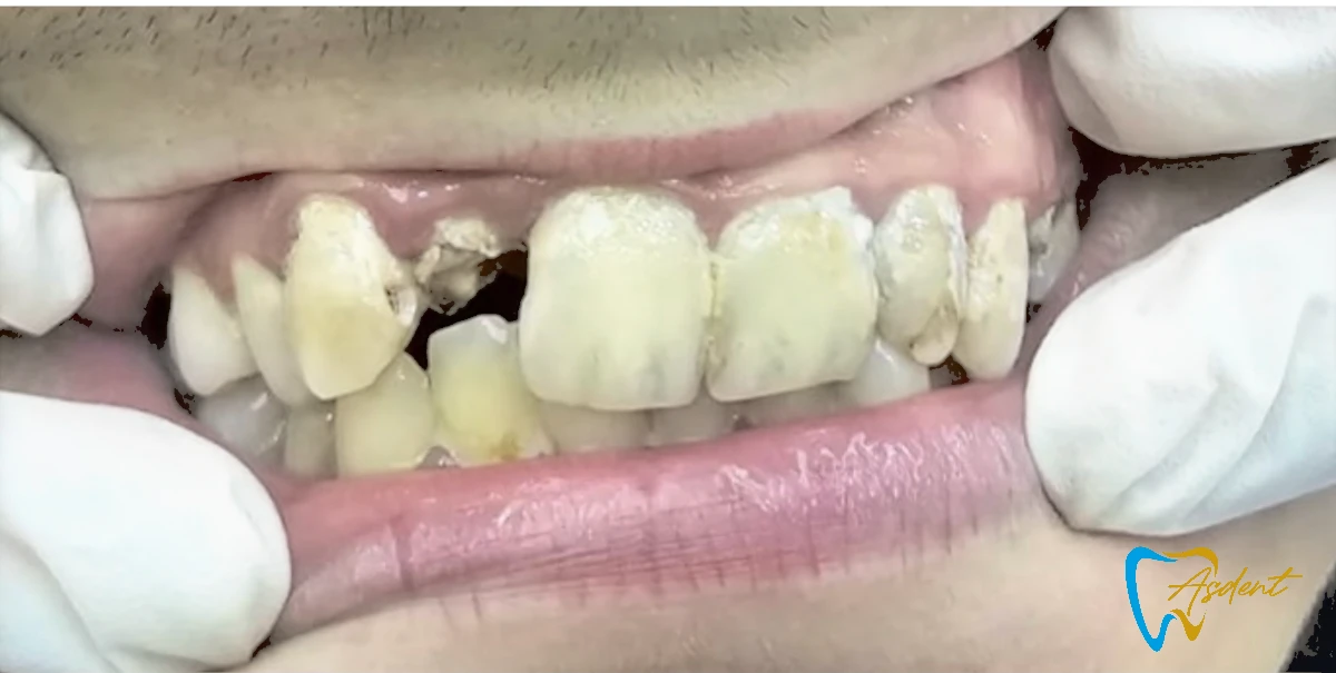 Dental-implants-in-Turkey-Dental-treatment-in-Turkey-Dental-clinic-in-Turkey-Before-5.webp