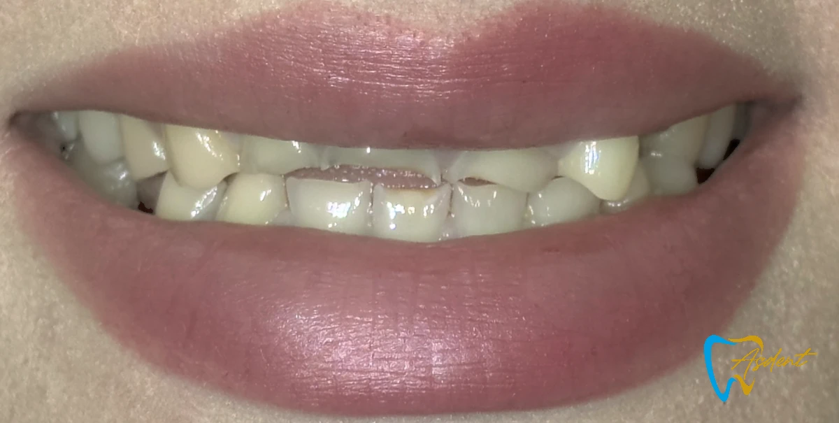 Dental-implants-in-Turkey-Dental-treatment-in-Turkey-Dental-clinic-in-Turkey-Before-6.webp