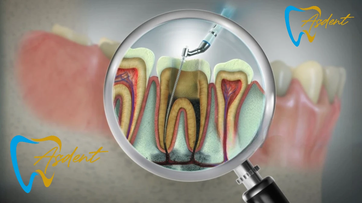Endodonti tedavisi, kanal tedavisi ASDENT Dental indegöl
