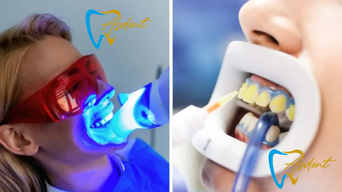 Teeth Whitening (Bleaching) in Turkey (2)