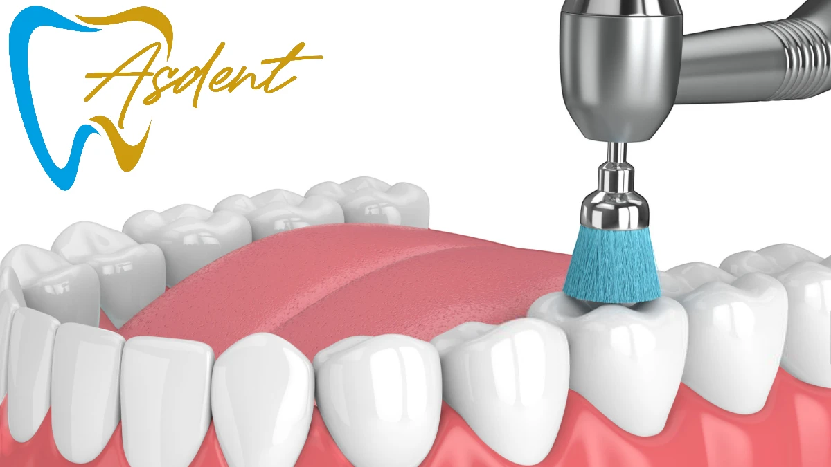 Teeth Whitening (Bleaching) in Turkey Bursa (2)