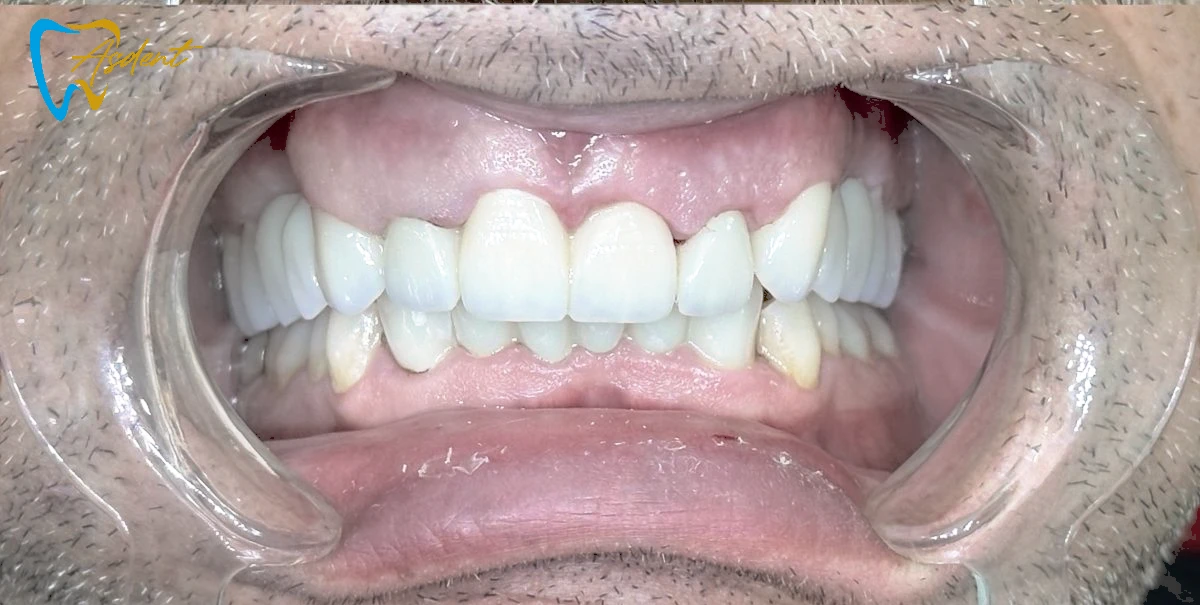 Dental implants in Turkey, Dental treatment in Turkey, Dental clinic in Turkey After 2 Dental implants in Turkey, Dental treatment in Turkey, Dental clinic in Turkey After 2