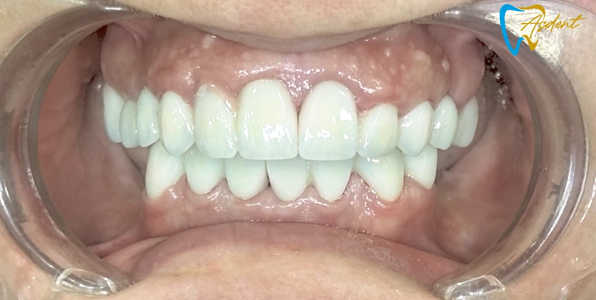 Dental implants in Turkey, Dental treatment in Turkey, Dental clinic in Turkey After 7 Dental implants in Turkey, Dental treatment in Turkey, Dental clinic in Turkey After 7
