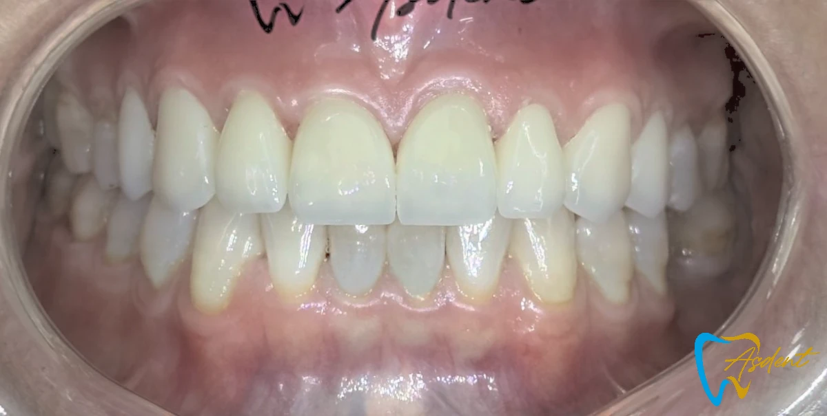 Dental implants in Turkey, Dental treatment in Turkey, Dental clinic in Turkey After1 Dental implants in Turkey, Dental treatment in Turkey, Dental clinic in Turkey After1