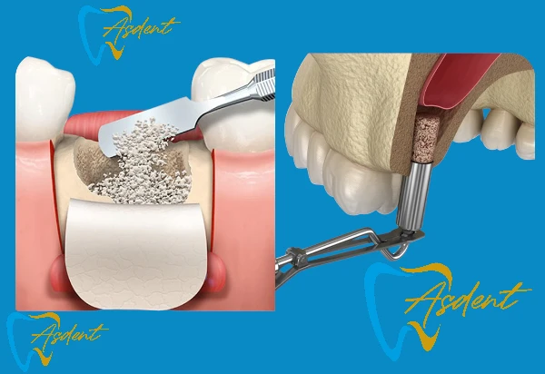 ASDENT Bone Graft and Sinus Lift + Implant Package in Turkey. (2)