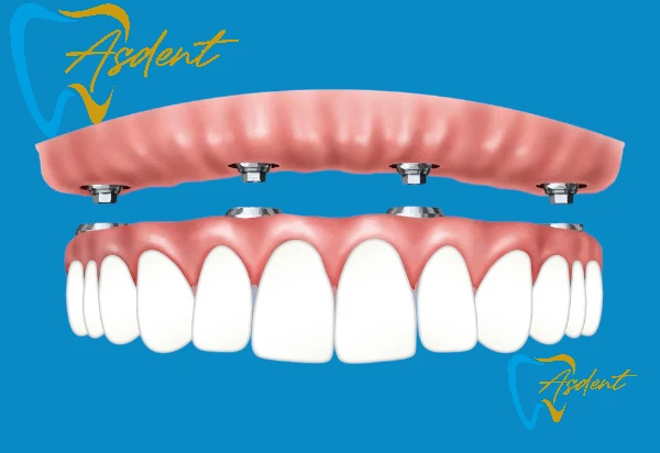 ASDENT all-on-4-dental-implants in Turkey