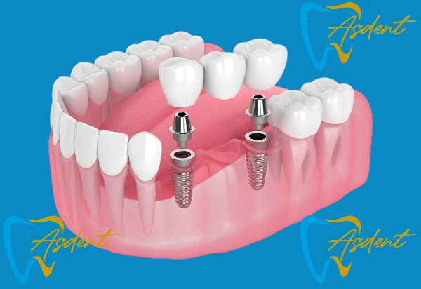 ASDENT single-and-multiple-dental-implants-in-Turkey