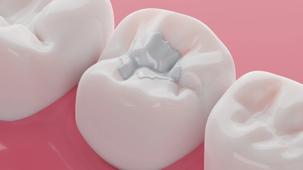 Composite filling procedure at ASDENT Dental Clinic in Turkey
