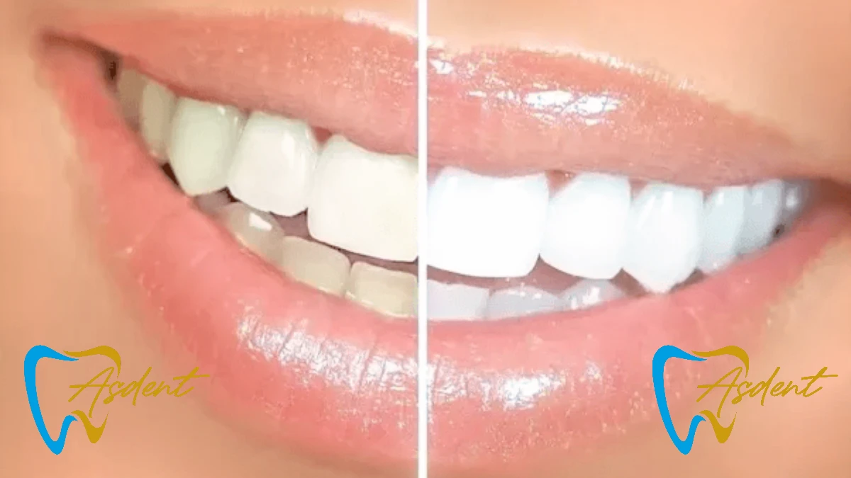Porcelain veneers and zirconium crowns applied by expert dentists at ASDENT Dental Clinic Turkey