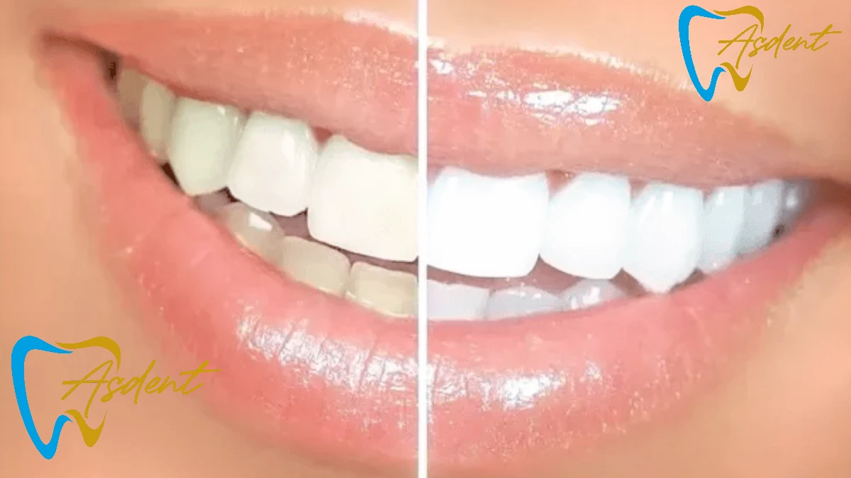 Teeth whitening in Turkey